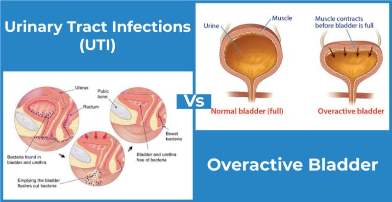 10 Ways to Control Your Overactive Bladder - Urologist Ahmedabad