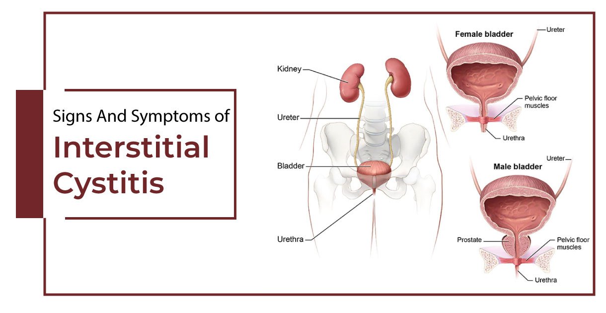 Interstitial Cystitis symptoms