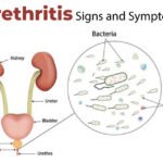 sign and symptoms of urethritis