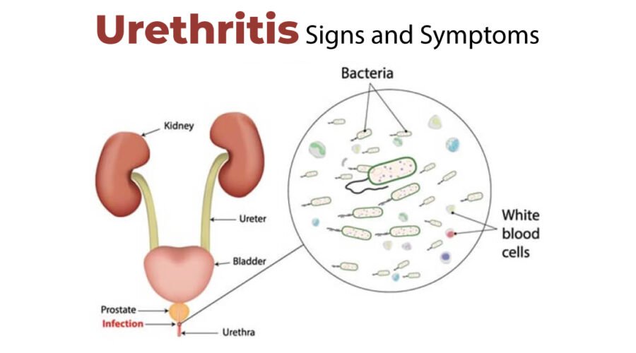 sign and symptoms of urethritis