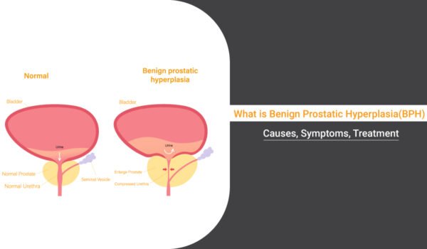 Pathophysiology Of Benign Prostate Hyperplasia Archives Urologist