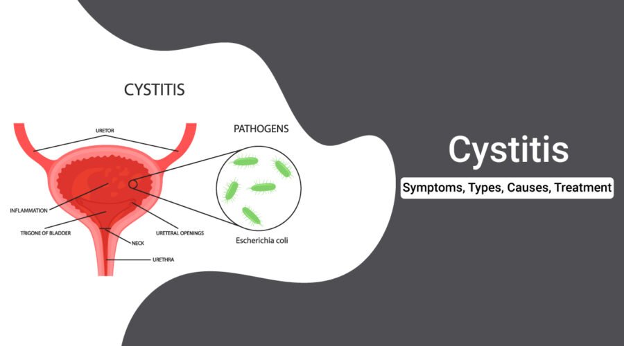 Cystitis-Symptoms-type-Treatment