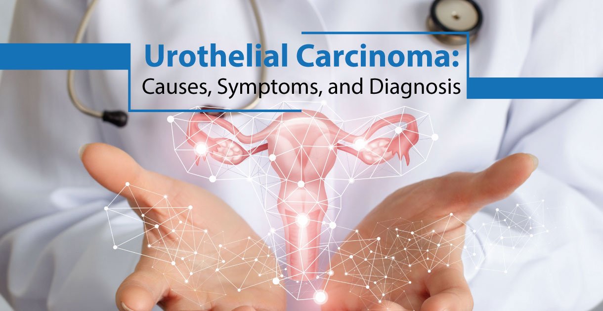 Urothelial Carcinoma An Overview