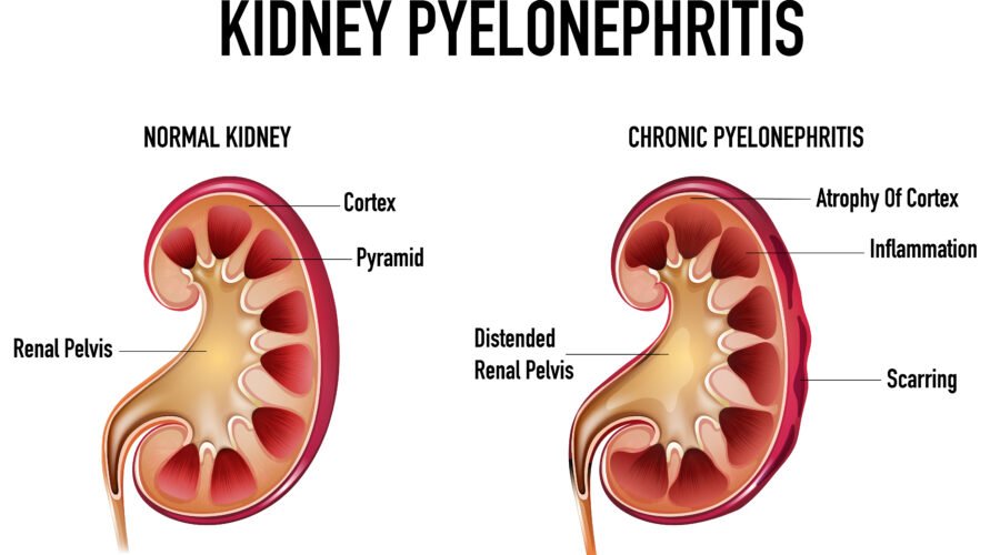 What is Pyelonephritis?