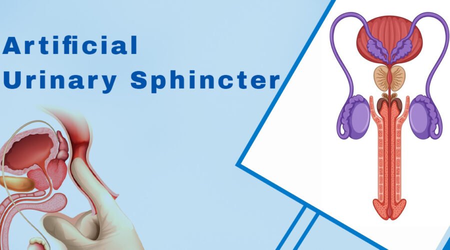 Artificial Urinary Sphincter in Incontinence Management