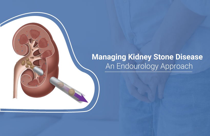 kidney stone diseases - Kidney Stones Managing