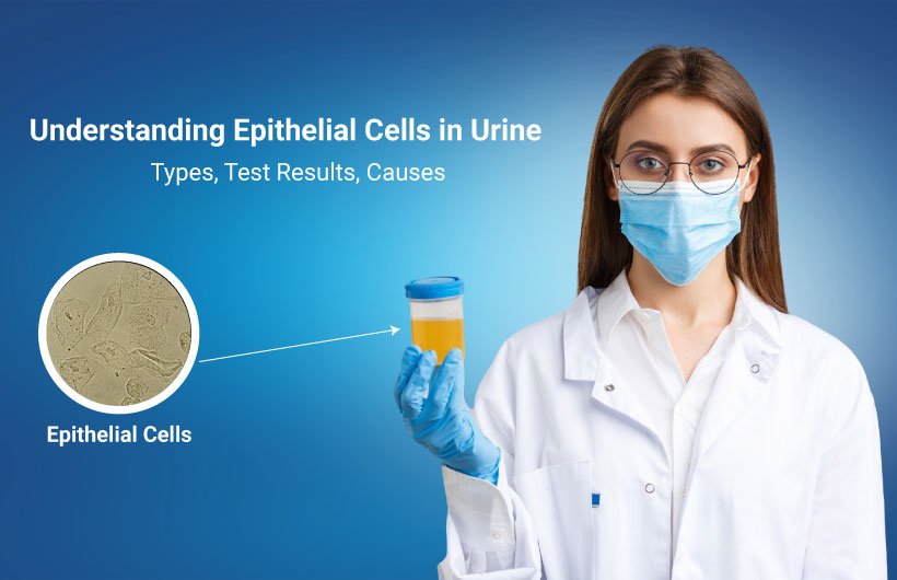 Causes of Epithelial Cells in Urine