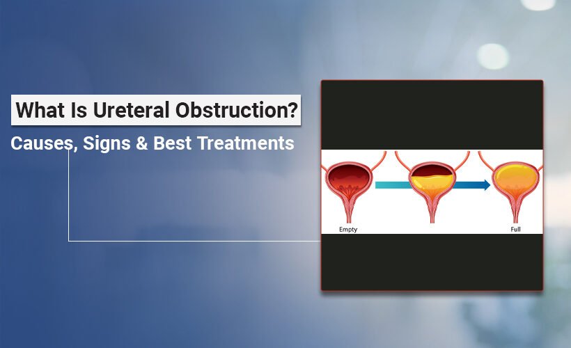 Ureteral Obstruction Causes and Treatment