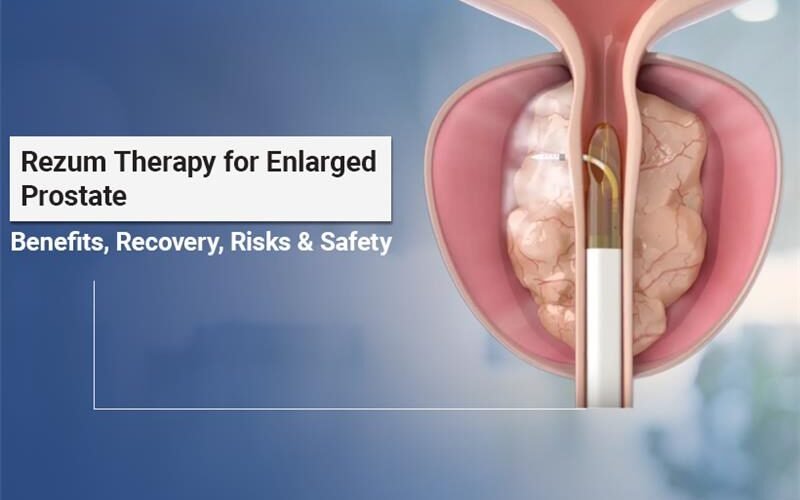 Rezum Therapy for prostate enlargement treatment without surgery