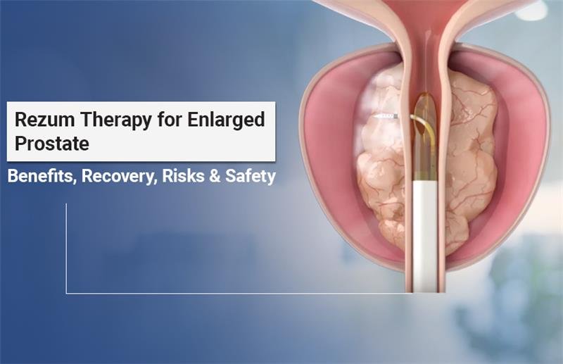 Rezum Therapy for prostate enlargement treatment without surgery