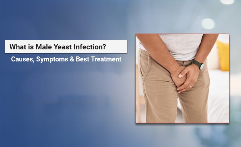 Male yeast infection treatment