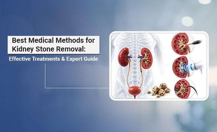 Best Medical Methods for Kidney Stone Removal