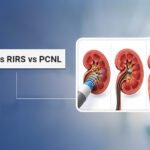 kidney stone treatment ahmedabad
