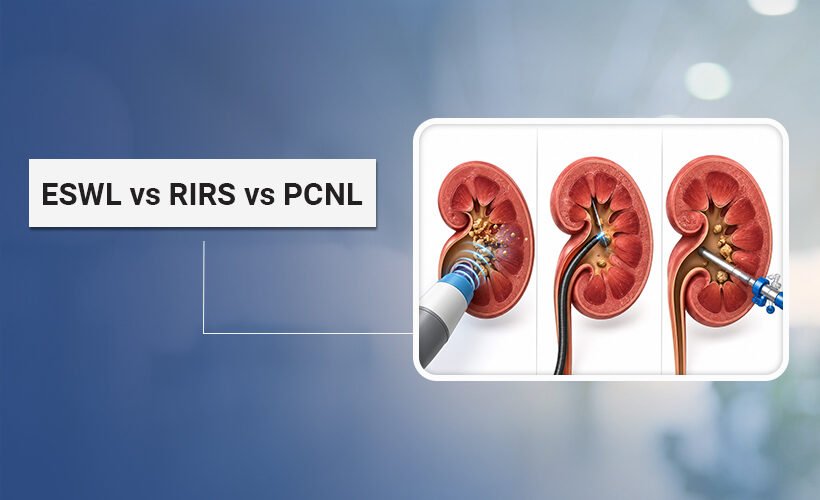 kidney stone treatment ahmedabad
