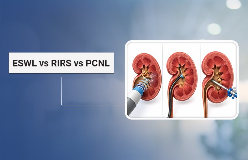 kidney stone treatment ahmedabad