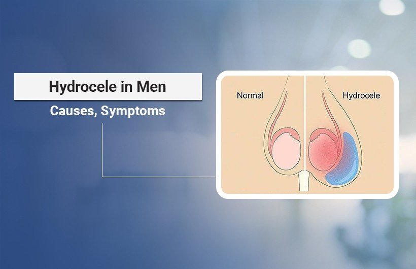 hydrocele treatment in Ahmedabad